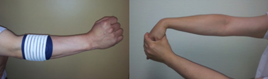 팔꿈치 보조기(좌)와 스트레칭 운동(우)으로 보존적 치료를 시행