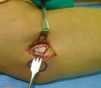 최소절개 수술적 치료법: 2~3 cm 피부를 절개 후에 병든 힘줄을 노출시키는 장면