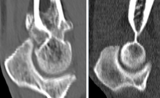 관절염환자(좌) 와 정상인(우)의 CT사진을 보면 관절염환자에서는 골극들이 생겨나서 서로 부딪히게 되는 사진