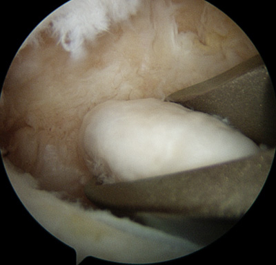 관절 안에 돌아다니는 뼈 조각을 관절경을 이용하여 제거하는 사진