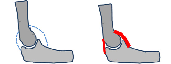 정상 관절낭(좌)과 구축된 관절낭(우)